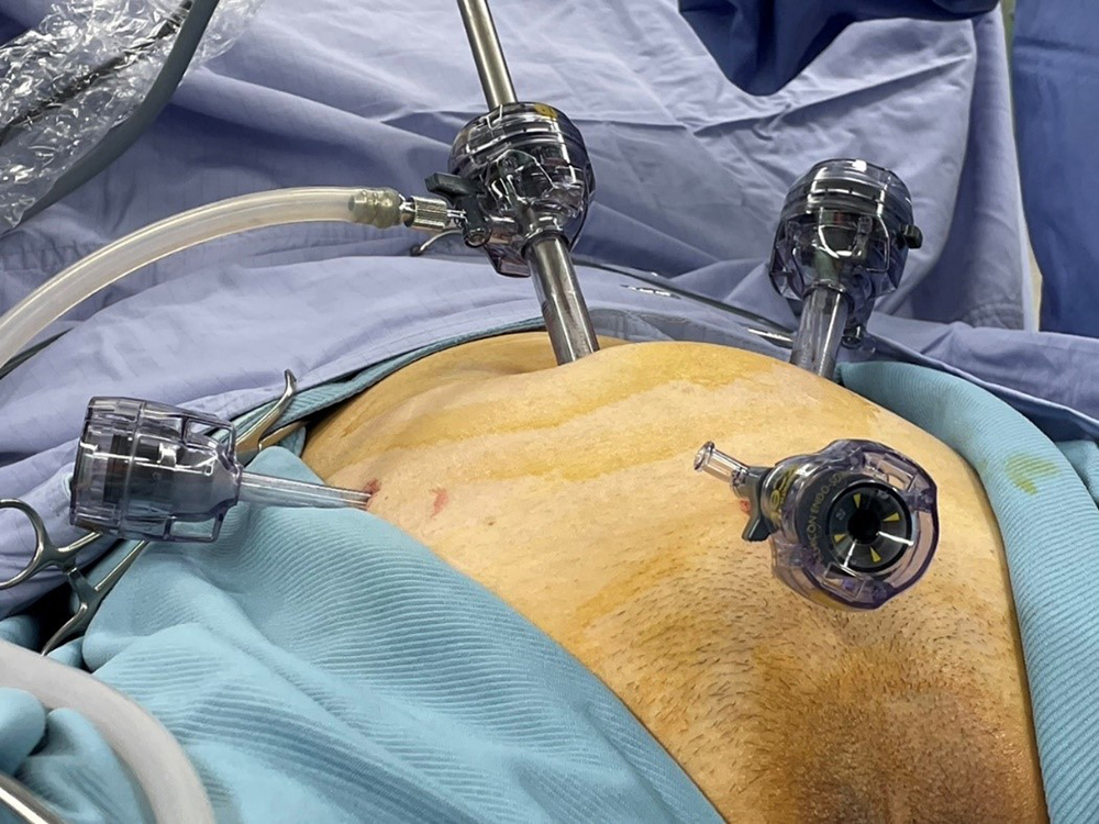 內視鏡微創手術