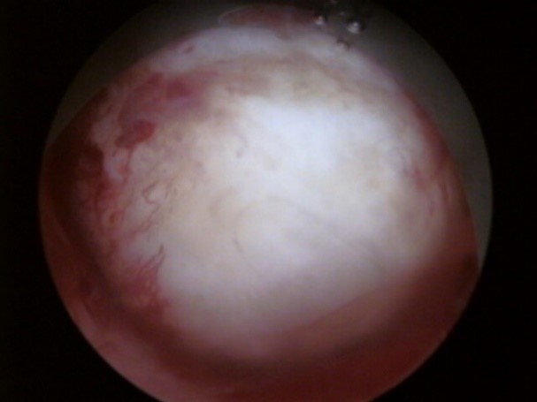 子宮黏膜下肌瘤