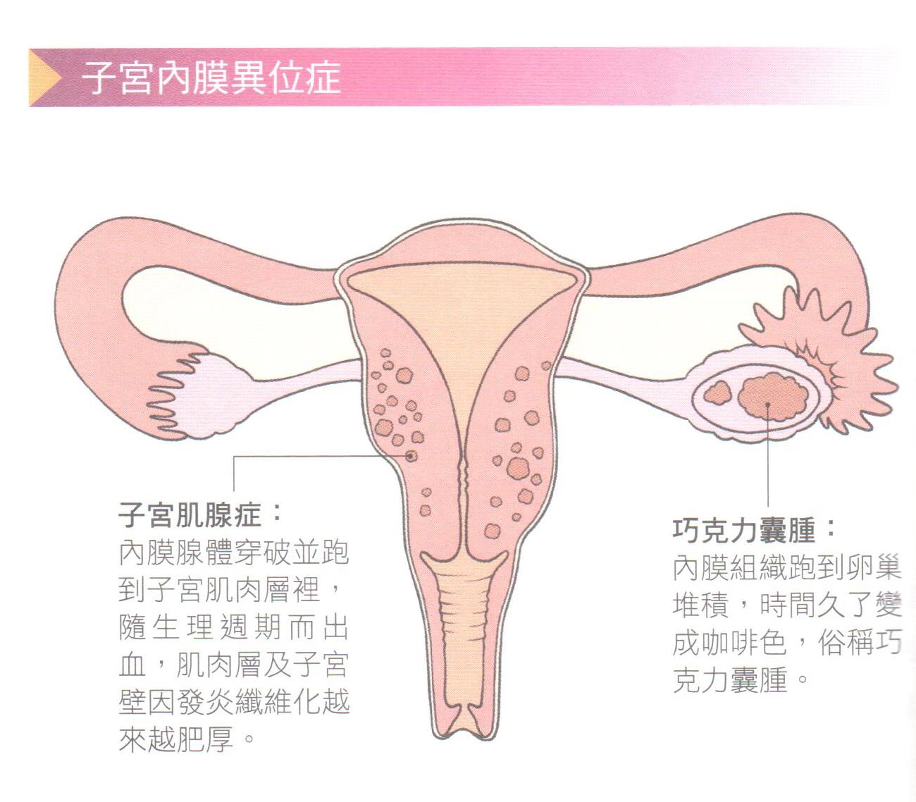 子宮內膜異位症