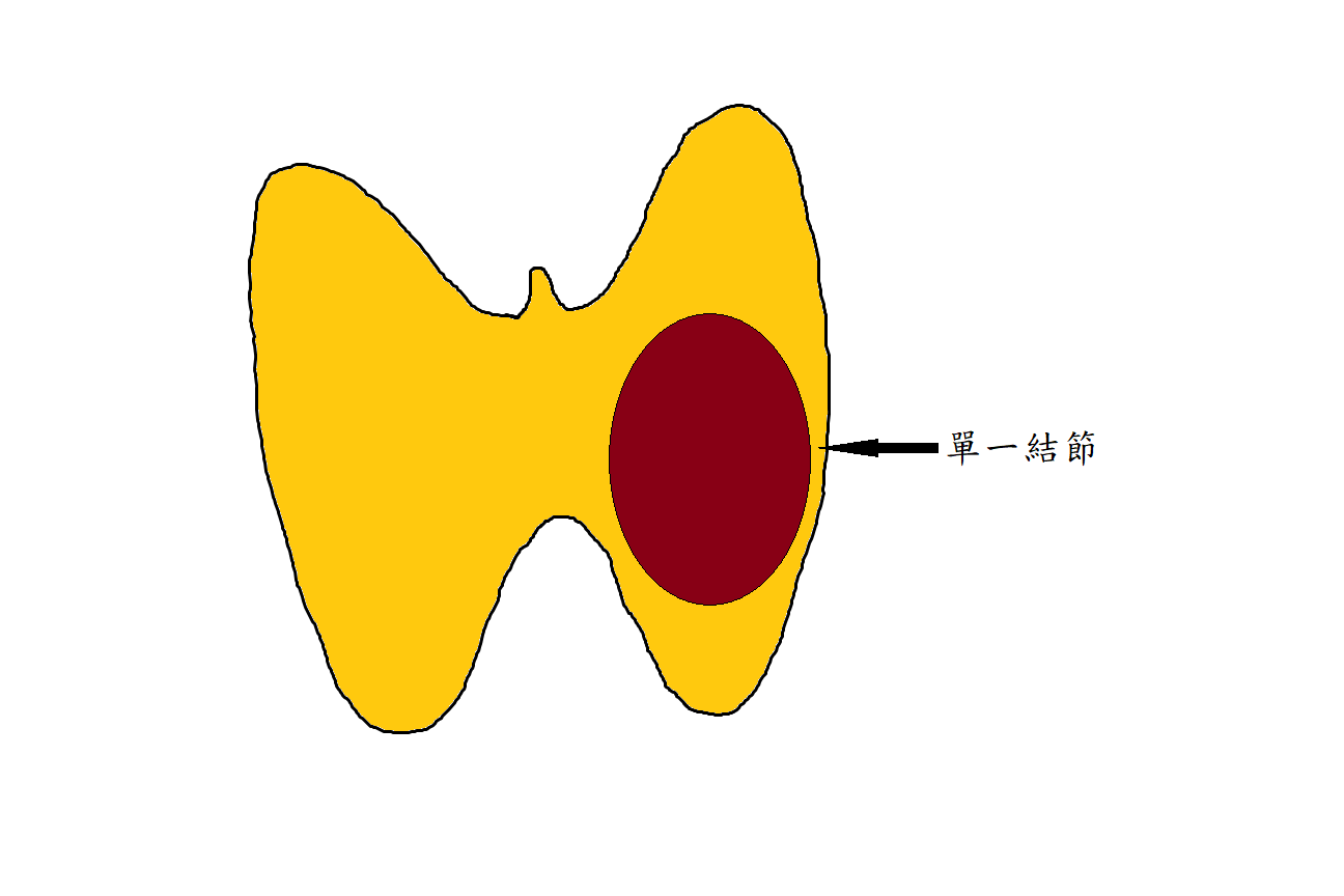 單一結節
