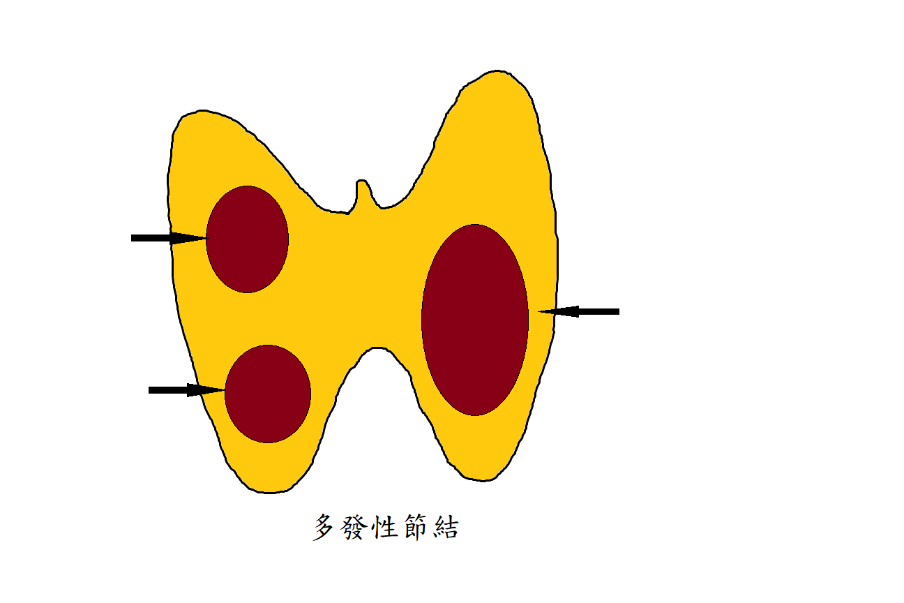 多發性結節