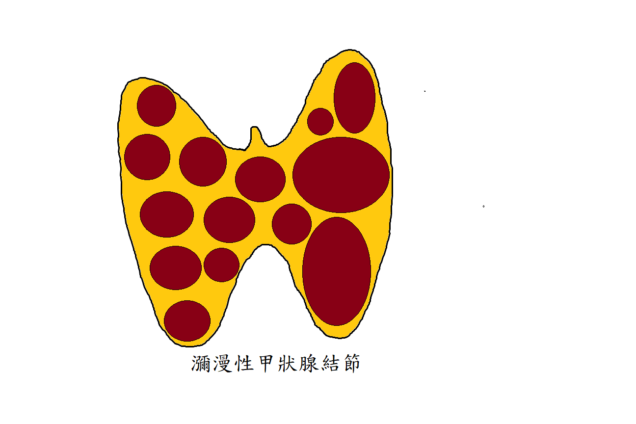 瀰漫性甲狀腺結節