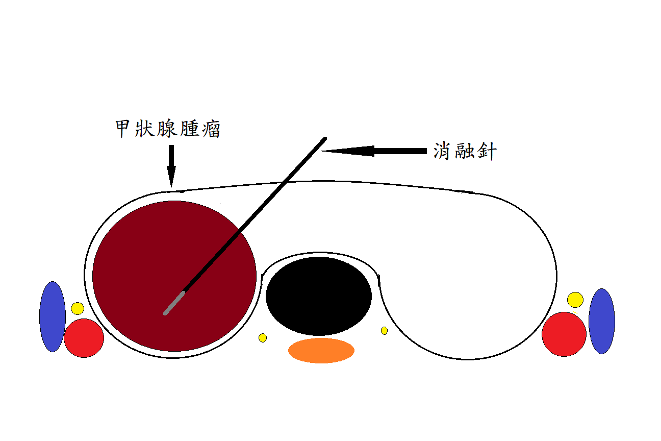 甲狀腺腫瘤、消融針