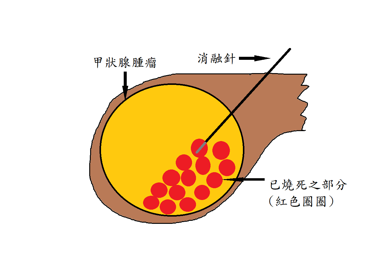 甲狀腺腫瘤、消融針、已燒死之部分(紅色圈圈)