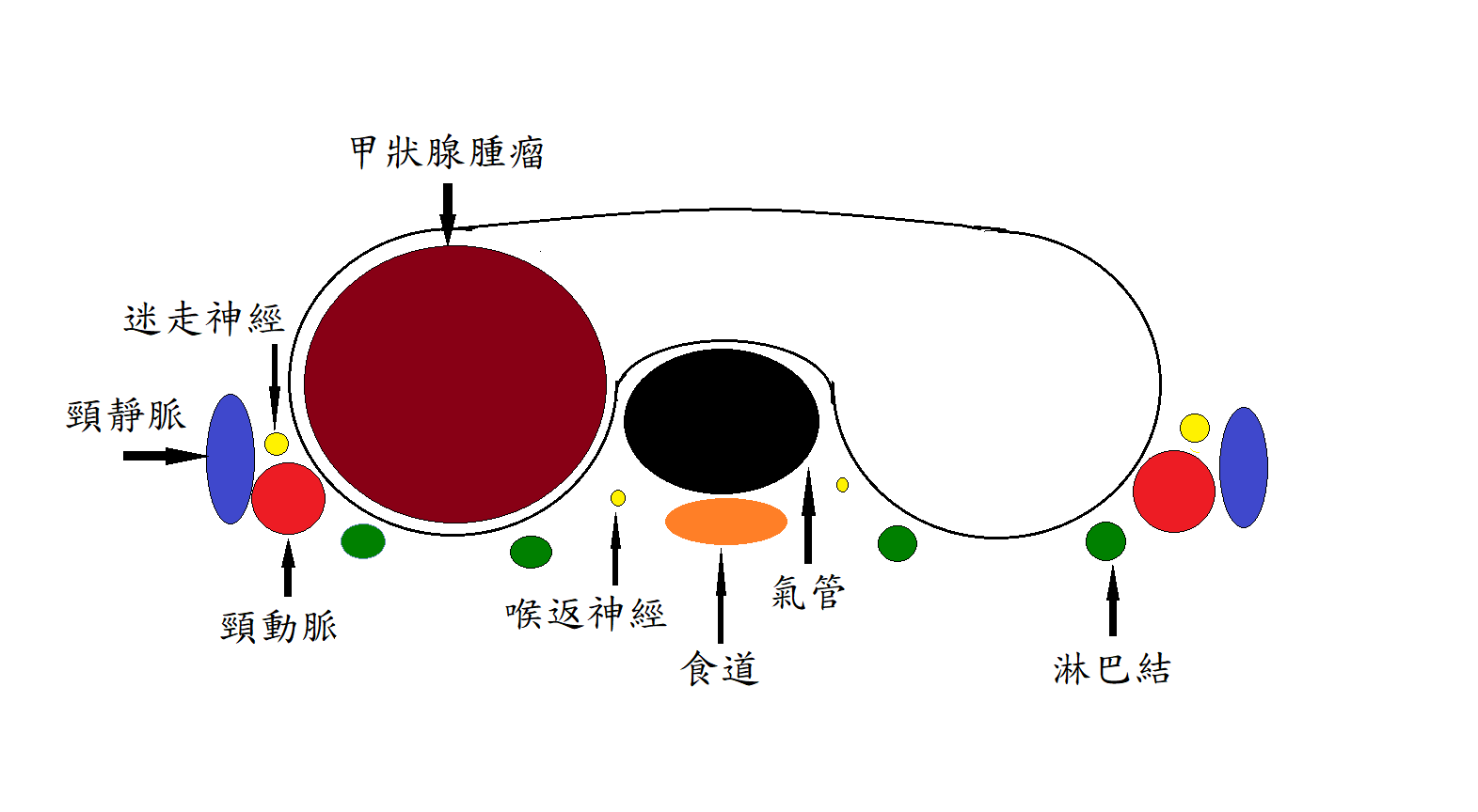 甲狀腺腫瘤、迷走神經、頸靜脈、頭靜脈、喉返神經、食道、氣管、淋巴結