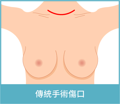 傳統手術傷口