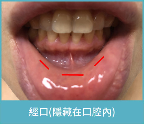 經口(隱藏在口腔內)