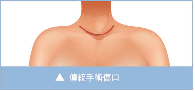 傳統手術傷口