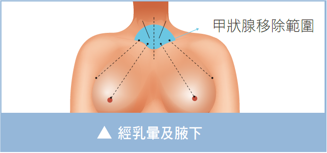 傳統手術傷口