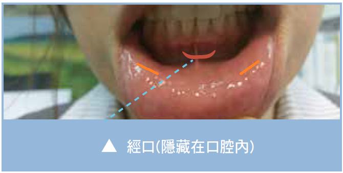 傳統手術傷口