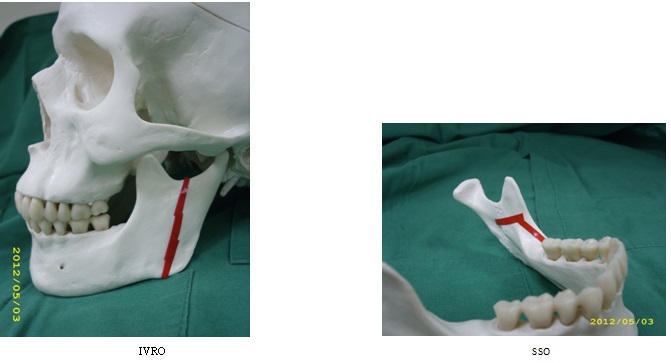 下顎骨垂直枝截骨術及下顎骨矢狀劈開術
