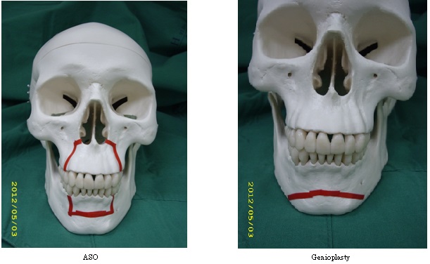前顎根尖下截骨術及頦成型術
