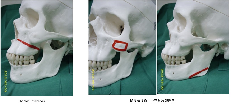 勒福一型截骨術及顴骨磨骨術、下顎骨角切除術