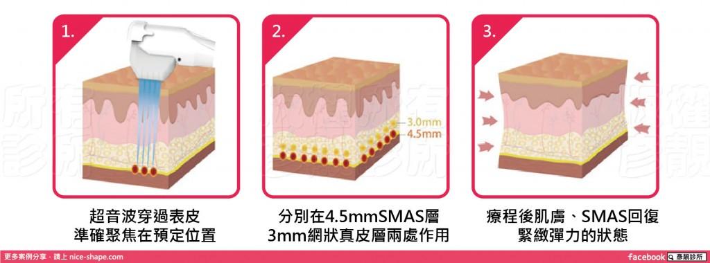 作用深度與治療面積