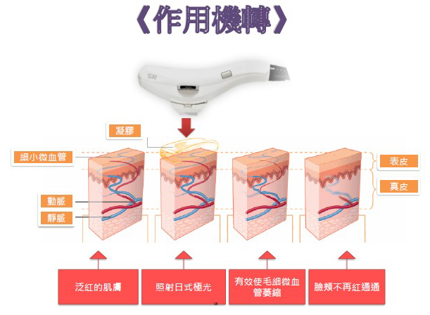 微血管擴張