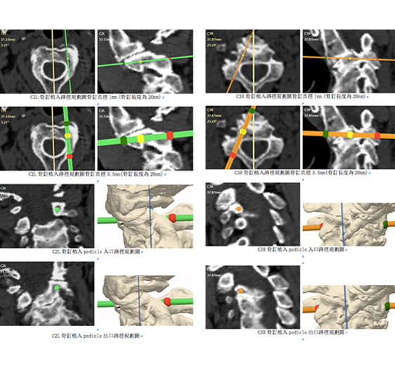 手術前的脊椎模型3D列印及手術路徑規畫