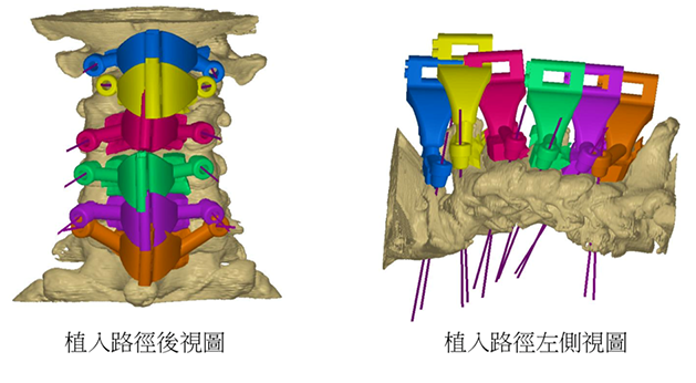 手術前的模擬手術圖