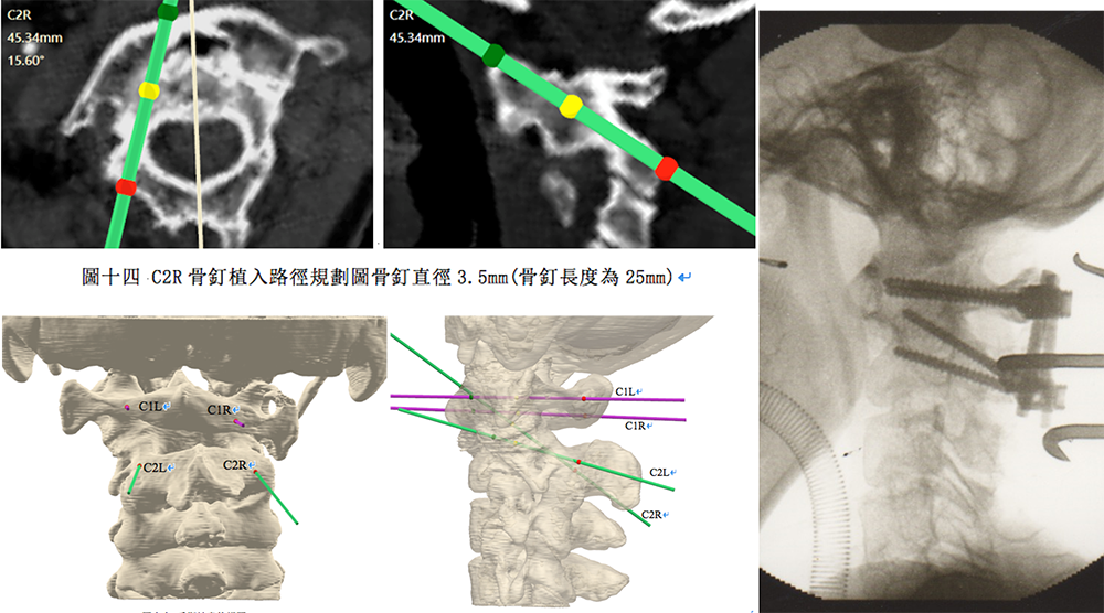 第一、第二頸椎脫位病人，術前模擬圖示及手術及時照片