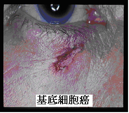 基底細胞癌